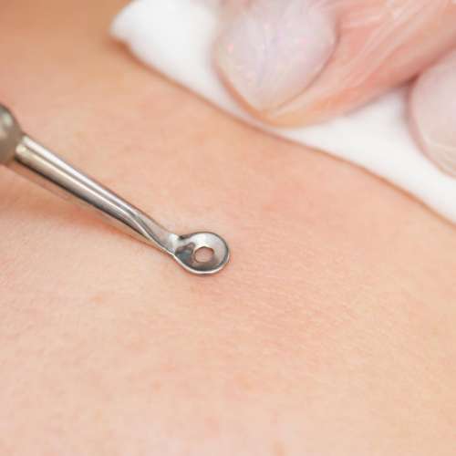 Дерматология и косметология: кюретки, блант-канюли, punch-биопсия — как выбирать диаметр и заточку