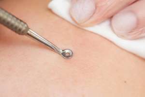 Дерматология и косметология: кюретки, блант-канюли, punch-биопсия — как выбирать диаметр и заточку